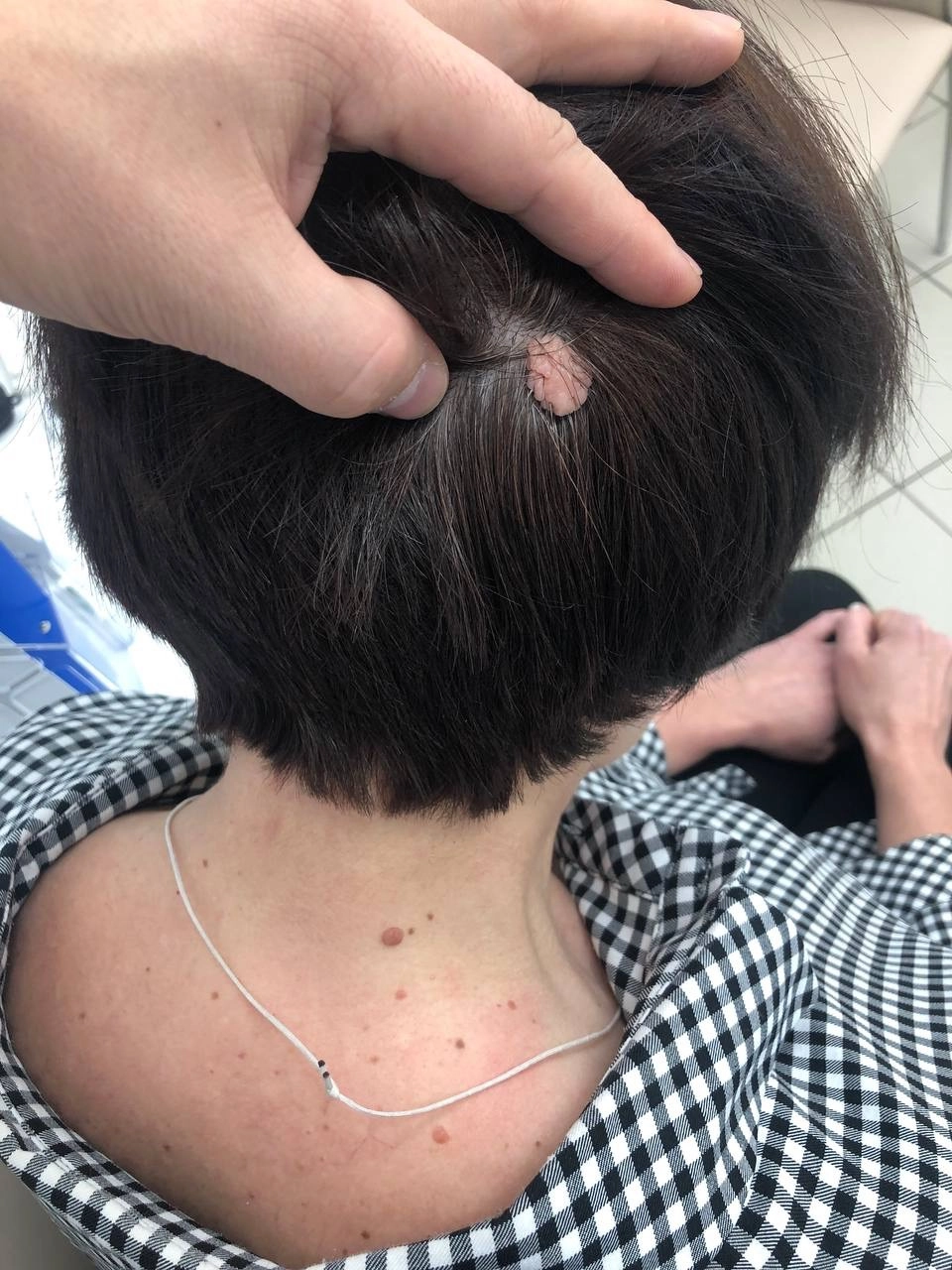 Удаление родинки на голове