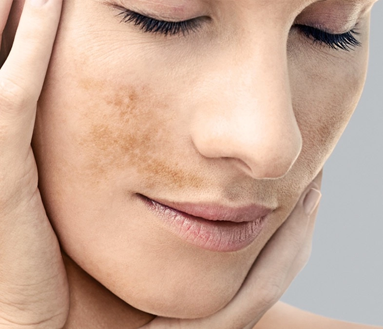 Пигментные пятна