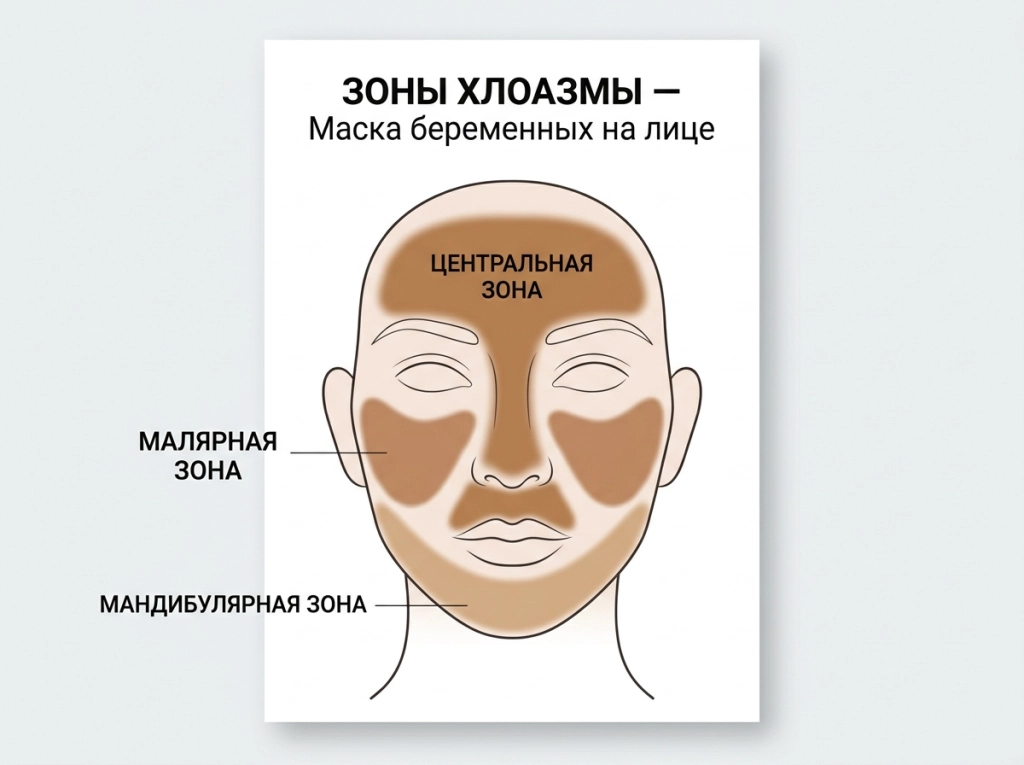 Зоны хлоазмы — маска беременных на лице
