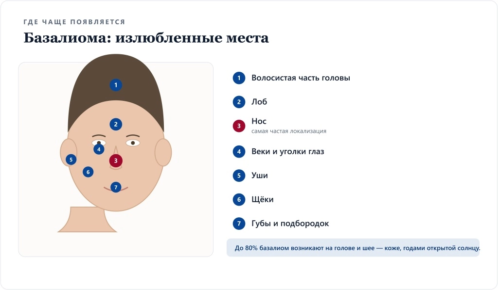 Где чаще появляется базалиома: нос, веки, уши, лоб, щёки, волосистая часть головы