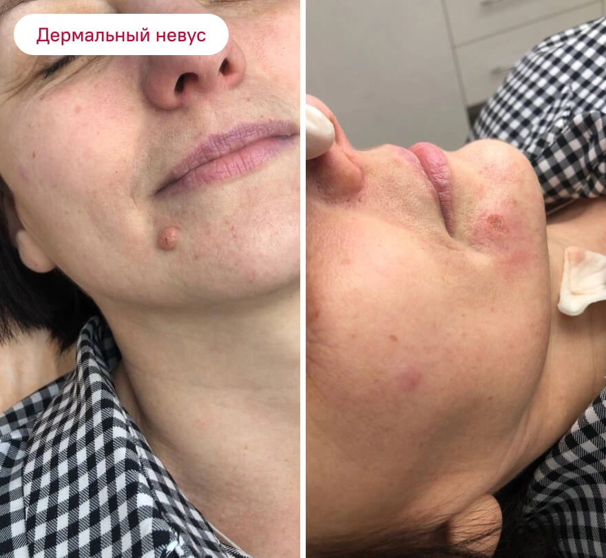 До и после: Дермальный невус
