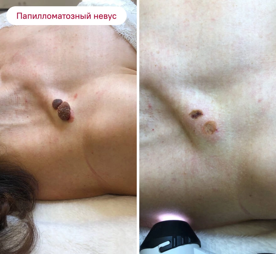 До и после: Папилломатозный невус